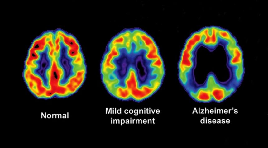 Brain scans revealing the cognitive difference between normally-functioning brains and brains affected by Alzheimer's. 